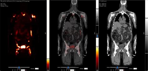 hermes medical solutions inc|hermes pet ct.